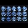 Read the Shocking Conclusions from 28 Medical Studies Linking Fluoride to Lower IQ in Children