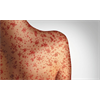 37% of Measles Cases Analyzed In The US In 2015 Were Caused By The MMR Vaccine
