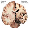 Did Radiation From Cell Phones Cause UK's 100% Increase in Early Dementia Starting at 30. Microwaves opens the blood-brain barrier, which may lead to early Alzheimer and other neurological diseases.