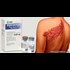 Thousands Sue Merck for Shingles Vaccine