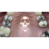 Wireless Technology: Ultra Convenient. Delivers Mercury Vapor from Dental Fillings - Free Shipping