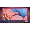 Measle-infected baby photos FAKED by NBC News to push mass hysteria and demand vaccine compliance