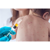 Government Research Confirms Measles Outbreaks are Transmitted by the Vaccinated